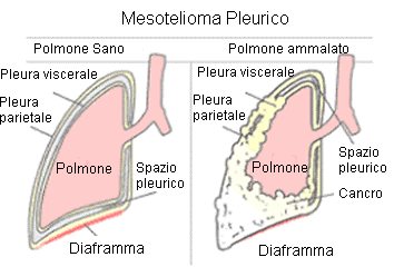 mesotelioma pleurico