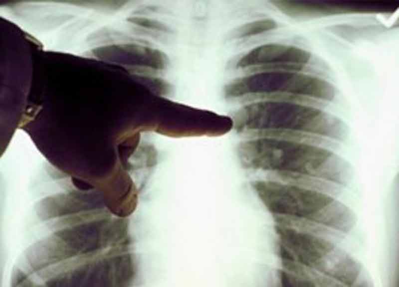 sintomi tumore polmonare