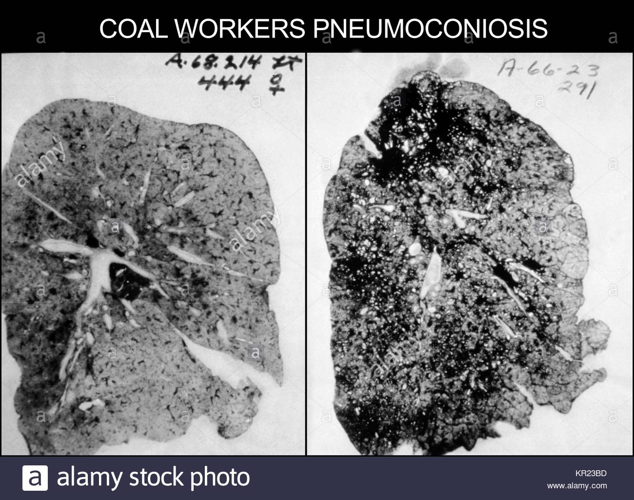 pneumoconiosi malattie polmonari
