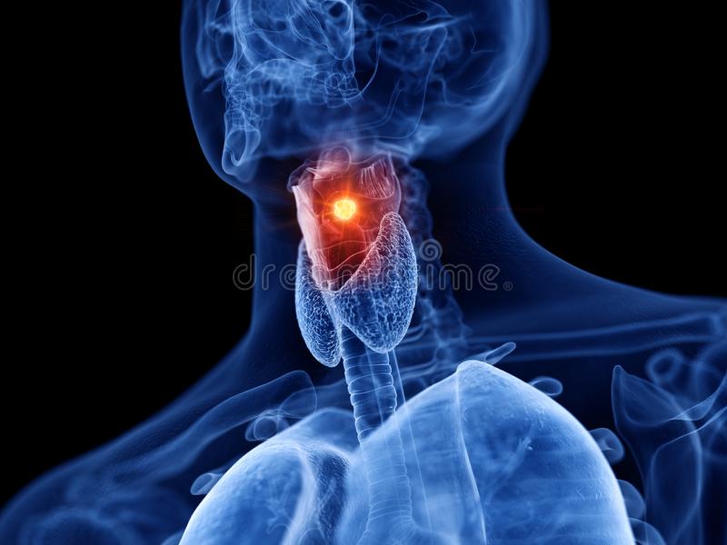 tumore alla laringe